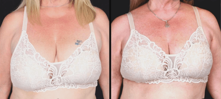 Bravona Forte  opinie 2