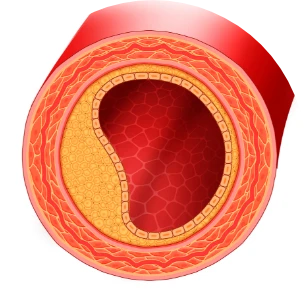 Cariovico przed kuracją