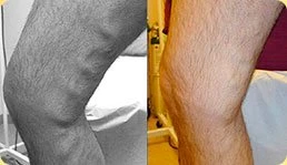 Varikosette opinia 2