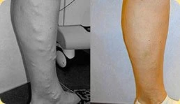 Varikosette opinia 3