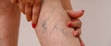 Veniselle na żylaki