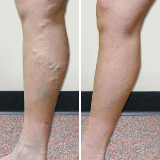 Veniseptico na obrzęki