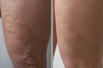 Veniseptico opinia 1