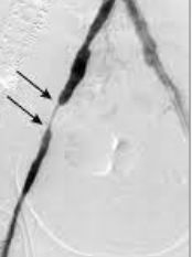 ravestin przed kuracją